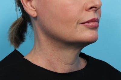 CoolSculpting Before & After Gallery - Patient 119279199 - Image 2