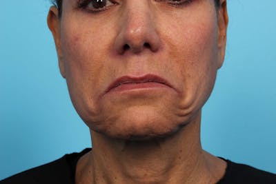 BOTOX<sup>®</sup> Before & After Gallery - Patient 119279244 - Image 1
