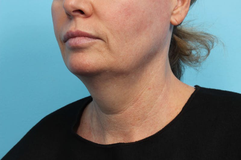 CoolSculpting Before & After Gallery - Patient 119279199 - Image 3
