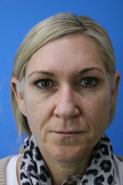 Juvéderm<sup>®</sup> Before & After Gallery - Patient 119279214 - Image 1