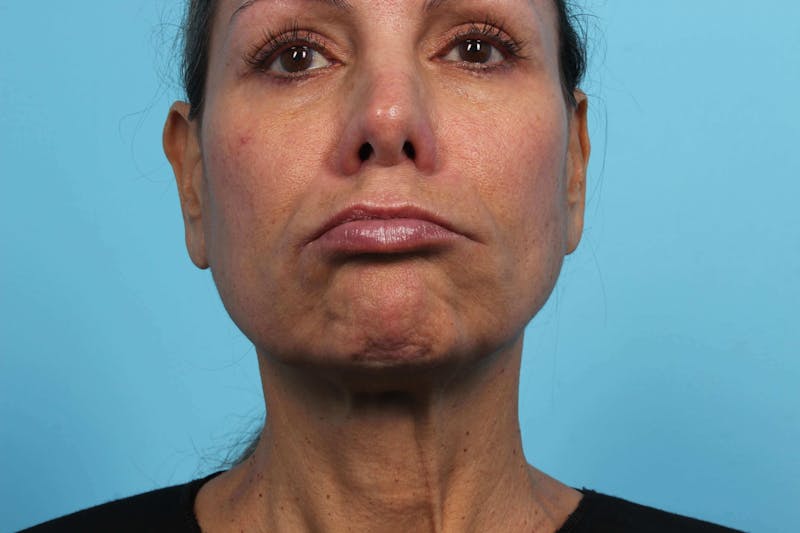 BOTOX<sup>®</sup> Before & After Gallery - Patient 119279244 - Image 2