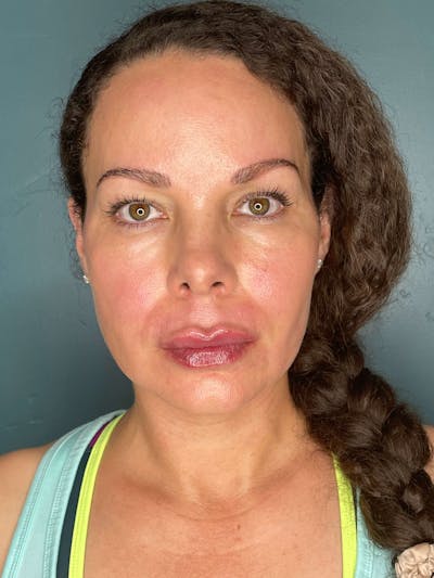Restylane<sup>®</sup> Before & After Gallery - Patient 119279200 - Image 2