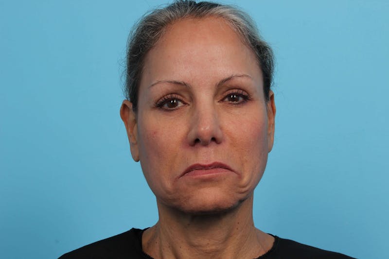 BOTOX<sup>®</sup> Before & After Gallery - Patient 119279244 - Image 3