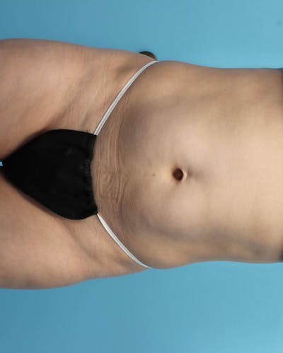 CoolSculpting Before & After Gallery - Patient 119279243 - Image 1