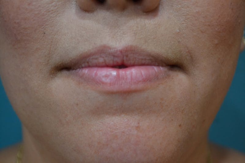 Restylane<sup>®</sup> Before & After Gallery - Patient 119279228 - Image 1