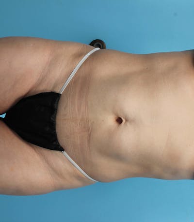 CoolSculpting Before & After Gallery - Patient 119279243 - Image 2