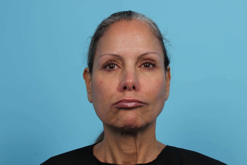 BOTOX<sup>®</sup> Before & After Gallery - Patient 119279244 - Image 4