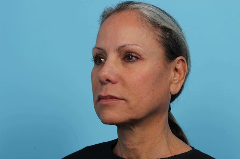 BOTOX<sup>®</sup> Before & After Gallery - Patient 119279244 - Image 5