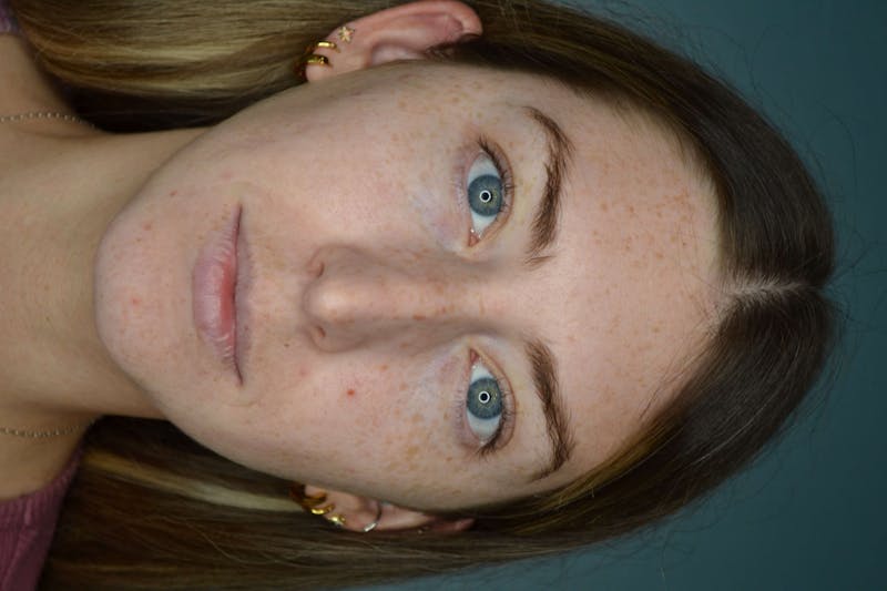 Restylane<sup>®</sup> Before & After Gallery - Patient 119279286 - Image 1