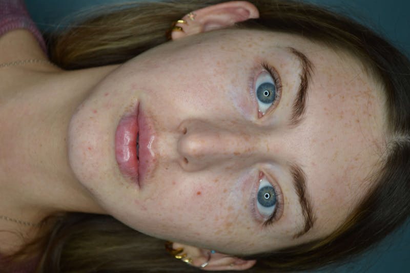 Restylane<sup>®</sup> Before & After Gallery - Patient 119279286 - Image 2