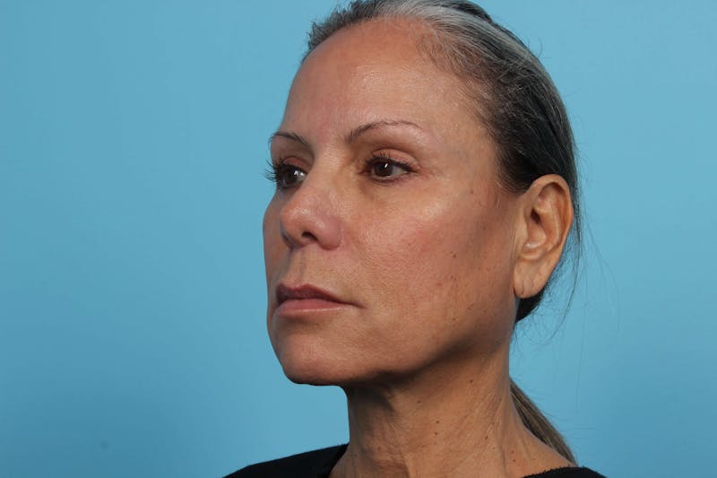 BOTOX<sup>®</sup> Before & After Gallery - Patient 119279244 - Image 6