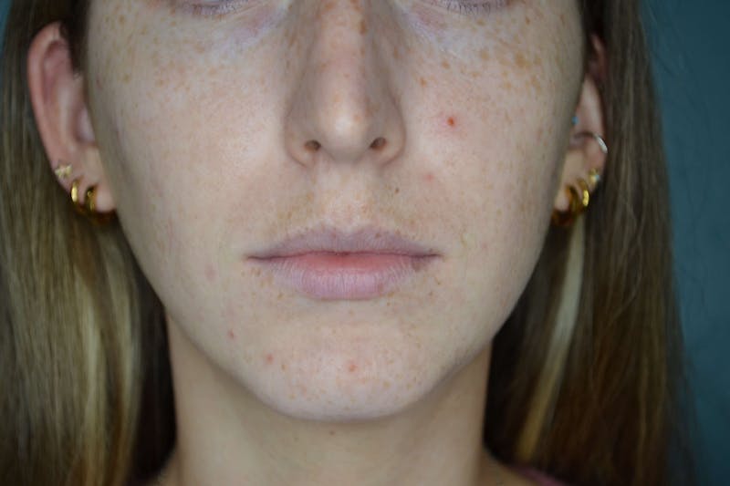 Restylane<sup>®</sup> Before & After Gallery - Patient 119279286 - Image 3