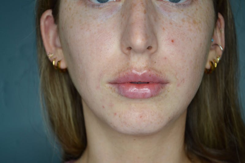 Restylane<sup>®</sup> Before & After Gallery - Patient 119279286 - Image 4