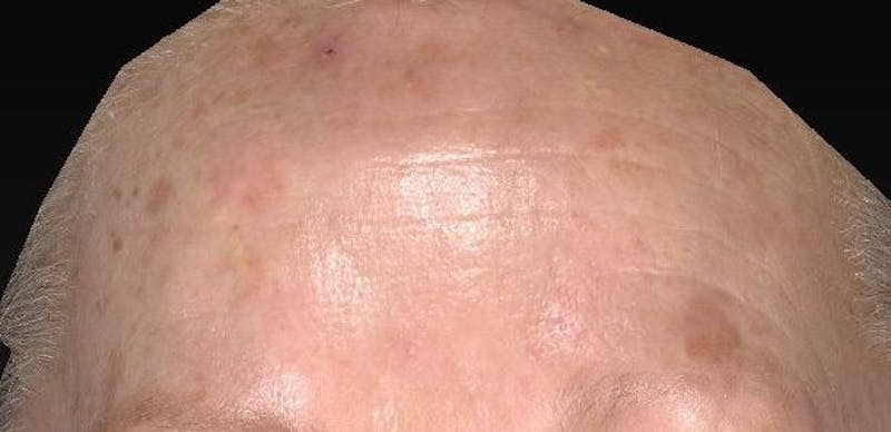 IPL and Pigment Therapy Before & After Gallery - Patient 119279320 - Image 3