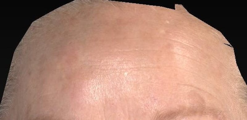 IPL and Pigment Therapy Before & After Gallery - Patient 119279320 - Image 4