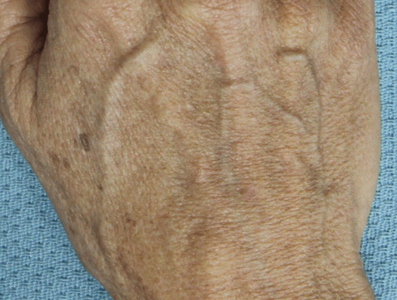 IPL and Pigment Therapy Before & After Gallery - Patient 119279342 - Image 1