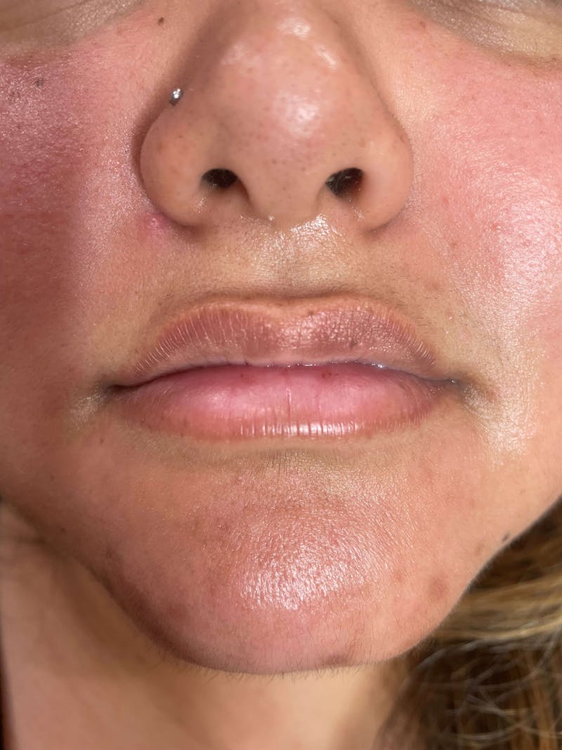 Restylane<sup>®</sup> Before & After Gallery - Patient 119279430 - Image 3