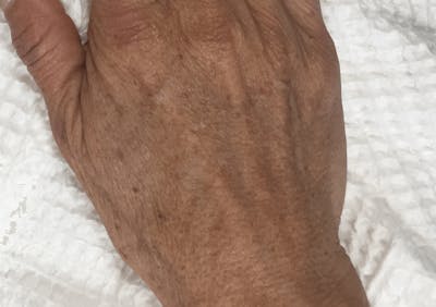 IPL and Pigment Therapy Before & After Gallery - Patient 119279342 - Image 2