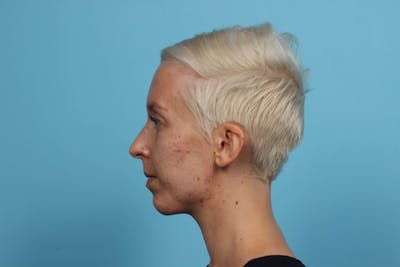 Radiesse<sup>®</sup> Before & After Gallery - Patient 119279512 - Image 2