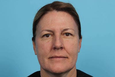 Laser Skin Resurfacing Before & After Gallery - Patient 119279514 - Image 2