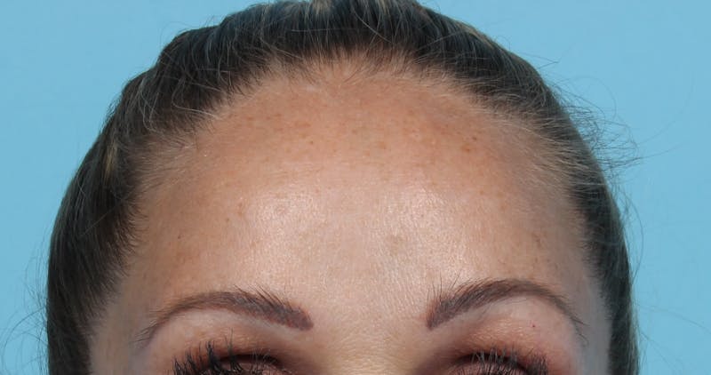 IPL and Pigment Therapy Before & After Gallery - Patient 119279491 - Image 1
