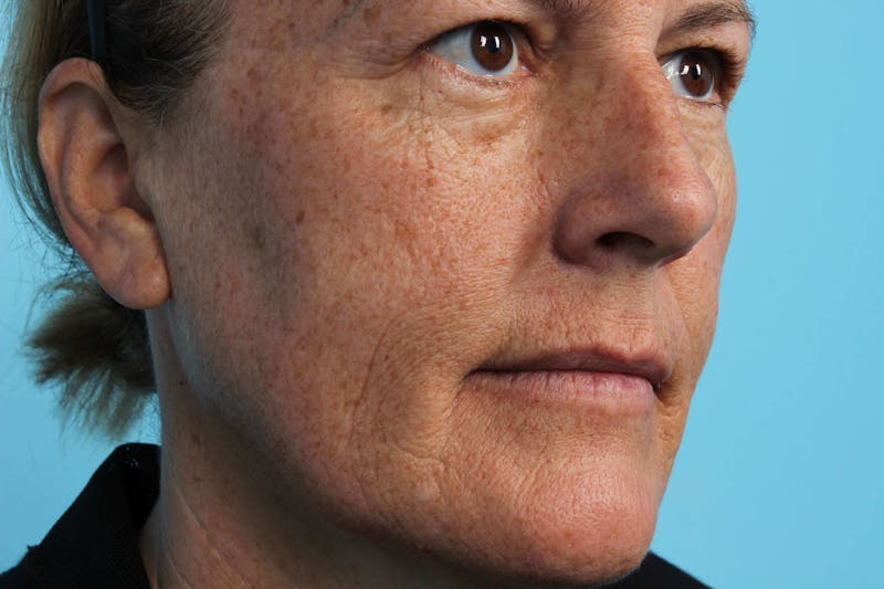 Laser Skin Resurfacing Before & After Gallery - Patient 119279514 - Image 3