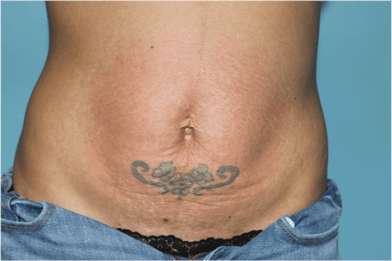 Laser Skin Tightening Before & After Gallery - Patient 119279471 - Image 2