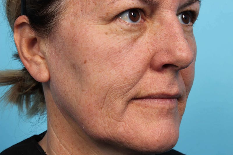 Laser Skin Resurfacing Before & After Gallery - Patient 119279514 - Image 4