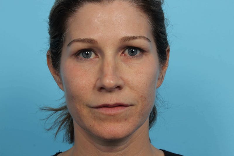 Restylane<sup>®</sup> Before & After Gallery - Patient 119279616 - Image 1