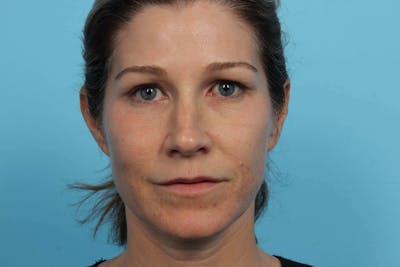 Restylane<sup>®</sup> Before & After Gallery - Patient 119279616 - Image 1