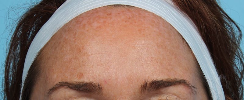 IPL and Pigment Therapy Before & After Gallery - Patient 119279513 - Image 1