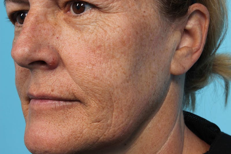 Laser Skin Resurfacing Before & After Gallery - Patient 119279514 - Image 5