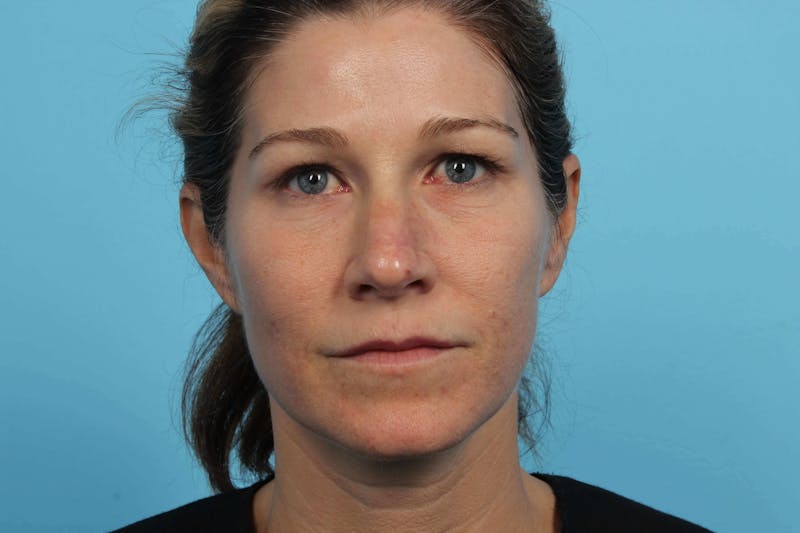 Restylane<sup>®</sup> Before & After Gallery - Patient 119279616 - Image 2