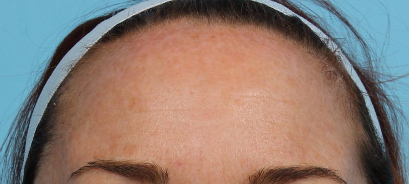IPL and Pigment Therapy Before & After Gallery - Patient 119279513 - Image 2