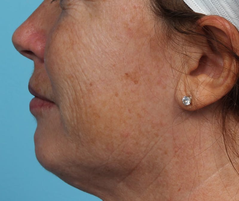 IPL and Pigment Therapy Before & After Gallery - Patient 119279513 - Image 3