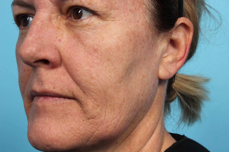 Laser Skin Resurfacing Before & After Gallery - Patient 119279514 - Image 6