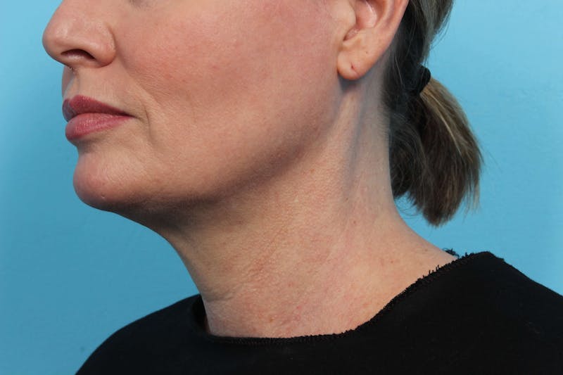 Laser Skin Tightening Before & After Gallery - Patient 119279515 - Image 4