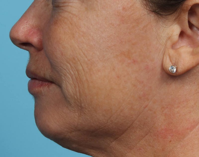 IPL and Pigment Therapy Before & After Gallery - Patient 119279513 - Image 4