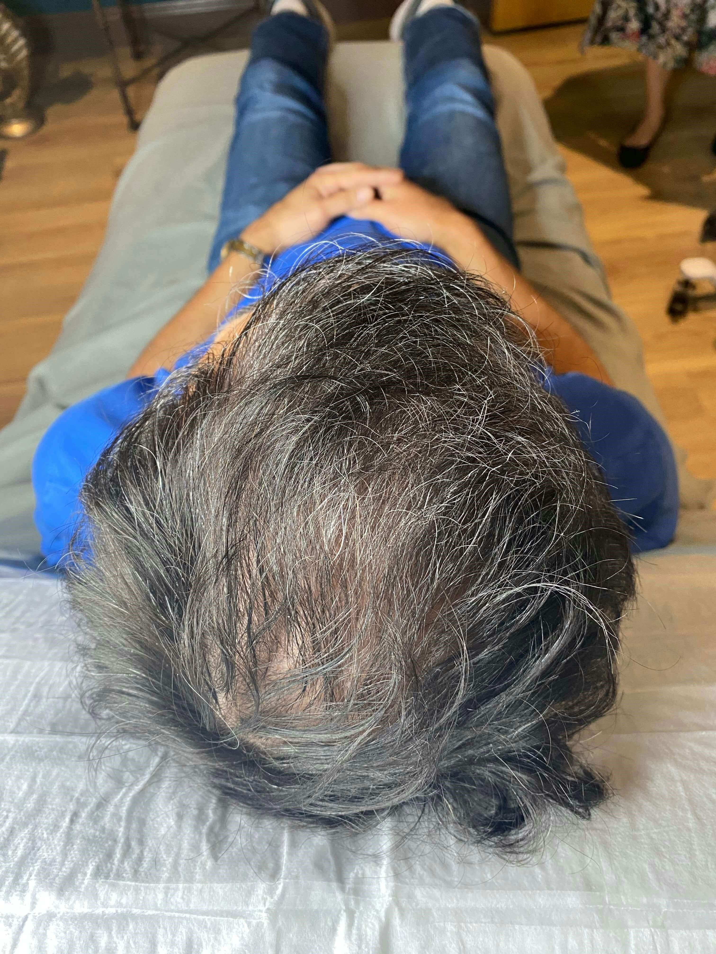 Microneedling