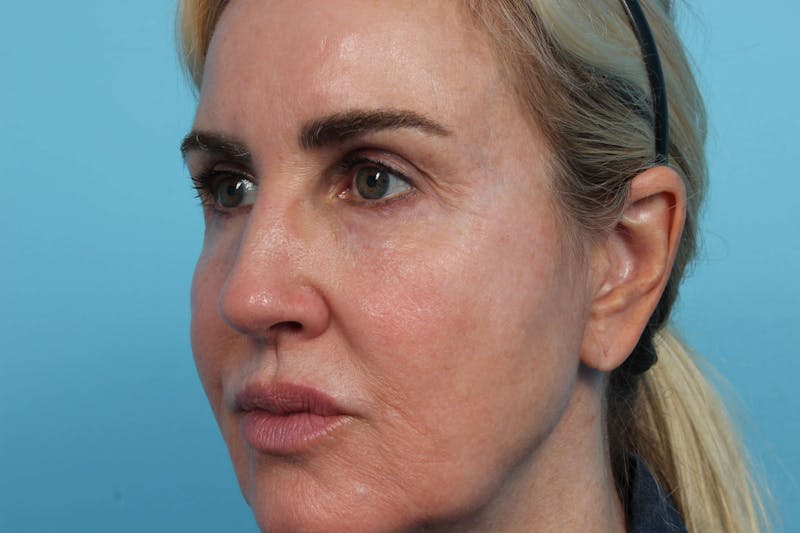 Laser Skin Resurfacing Before & After Gallery - Patient 119279596 - Image 1