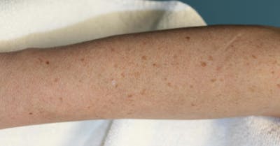 IPL and Pigment Therapy Before & After Gallery - Patient 119279592 - Image 1