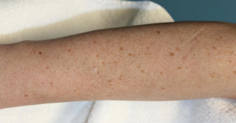 IPL and Pigment Therapy Before & After Gallery - Patient 119279592 - Image 1