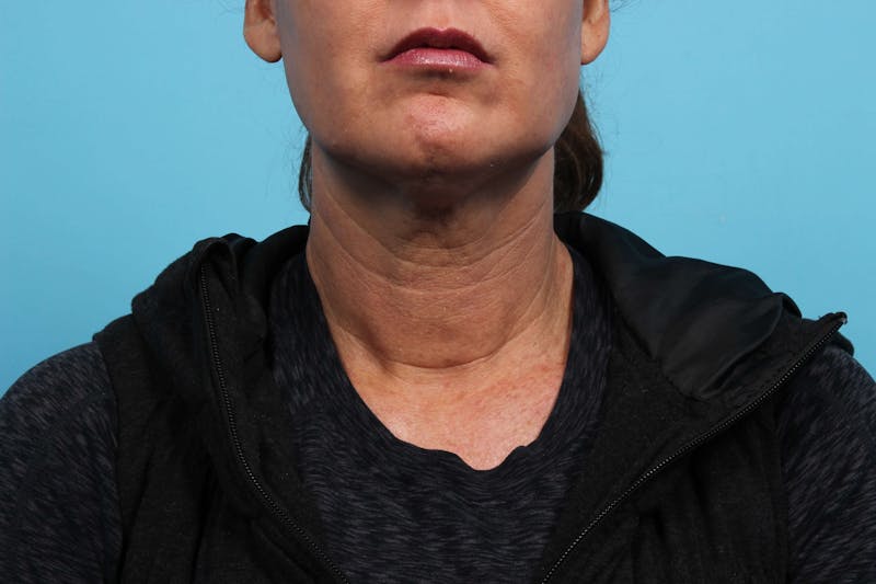 Laser Skin Tightening Before & After Gallery - Patient 119279610 - Image 1