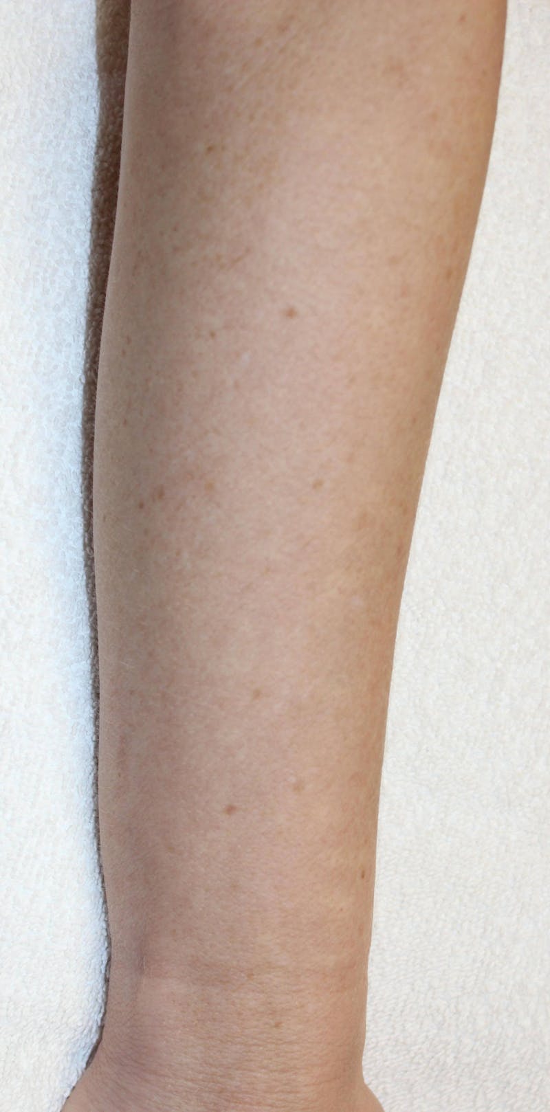 IPL and Pigment Therapy Before & After Gallery - Patient 119279592 - Image 2
