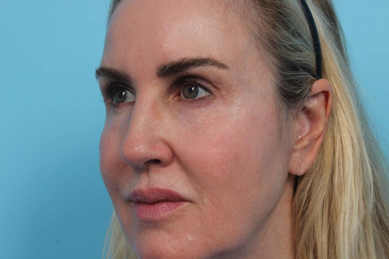 Laser Skin Resurfacing Before & After Gallery - Patient 119279596 - Image 2