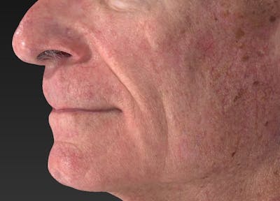 IPL and Pigment Therapy Before & After Gallery - Patient 119279611 - Image 1