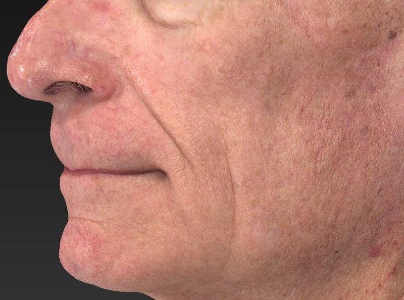 IPL and Pigment Therapy Before & After Gallery - Patient 119279611 - Image 2