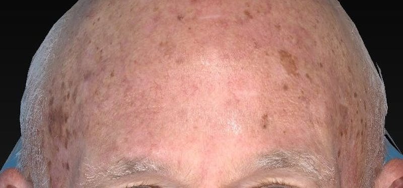IPL and Pigment Therapy Before & After Gallery - Patient 119279611 - Image 3