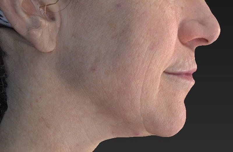 Laser Skin Resurfacing Before & After Gallery - Patient 119279612 - Image 1