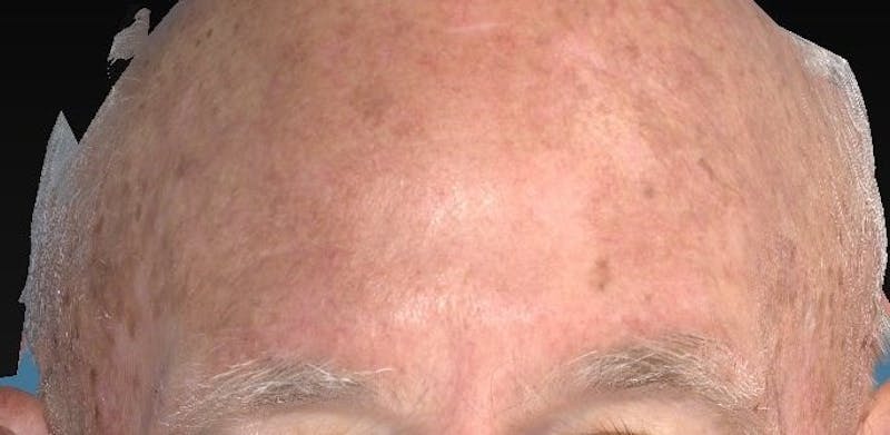 IPL and Pigment Therapy Before & After Gallery - Patient 119279611 - Image 4